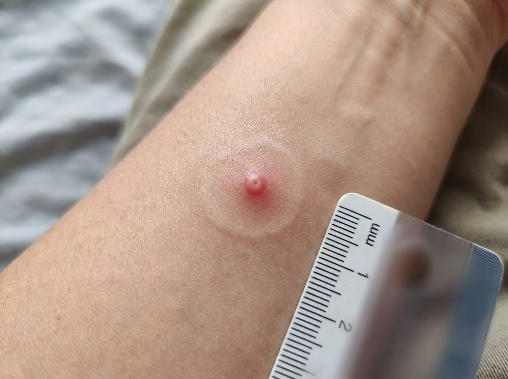 Close-up photo of a fresh red swollen sting welt on skin with a small central puncture mark