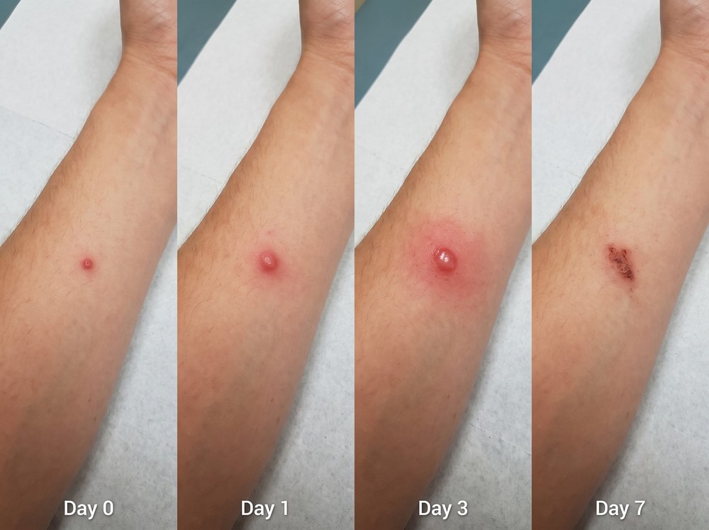 Four panel comparison photo showing a sting mark healing across day zero, day one, day three, and day seven